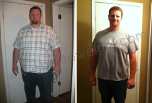 VSG - Vertical Sleeeve Gastrectomy