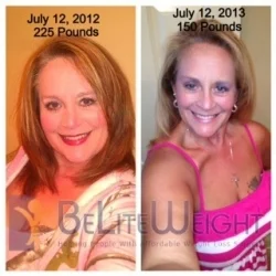 Gastric Sleeve Surgery Before and After