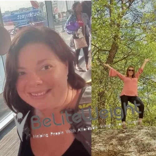 Weight Loss Surgery Gastric Sleeve before and after