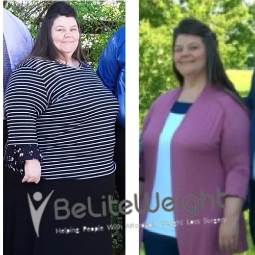 Weight Loss Surgery Before And After