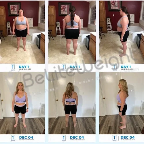 Weight Loss Surgery Before And After