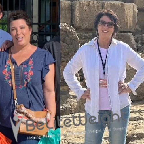 Weight Loss Surgery Gastric Sleeve before and after