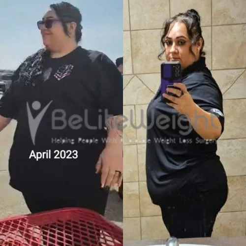 Weight Loss Surgery Before and After