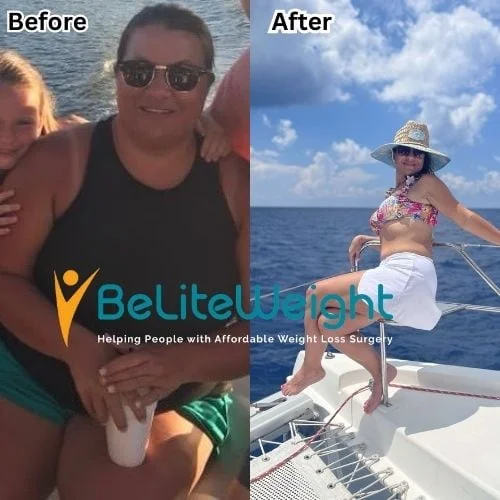 Adrian A -RNY gastric bypass - update after 4 years