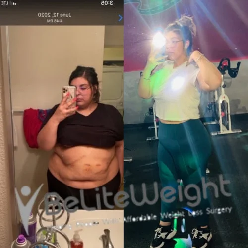 Weight Loss Surgery Before And After