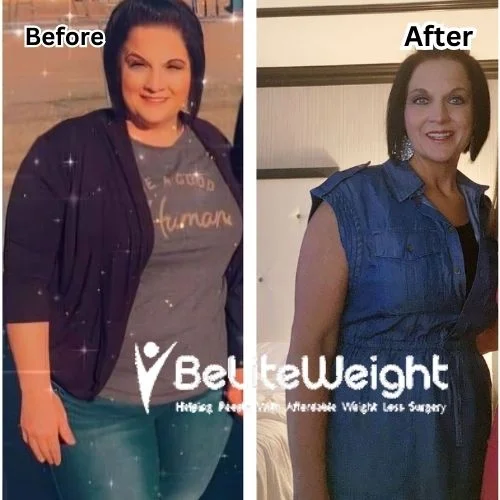 Weight Loss Surgery Gastric Sleeve before and after