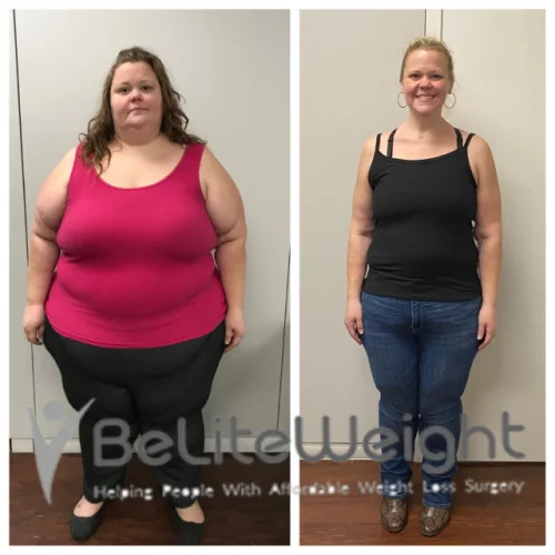 Weight Loss Surgery Before And After