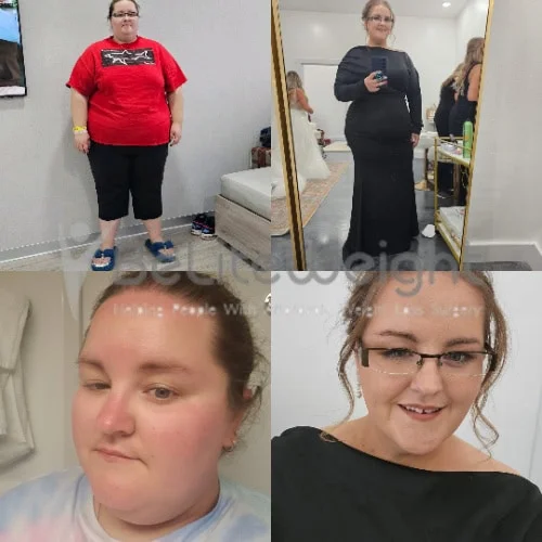 Weight Loss Surgery Before and After