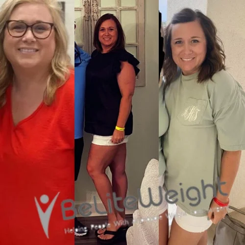 Weight Loss Surgery Gastric Sleeve before and after