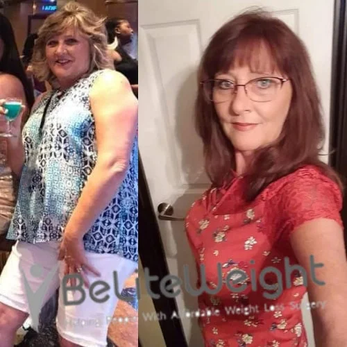 Weight Loss Surgery Gastric Sleeve before and after