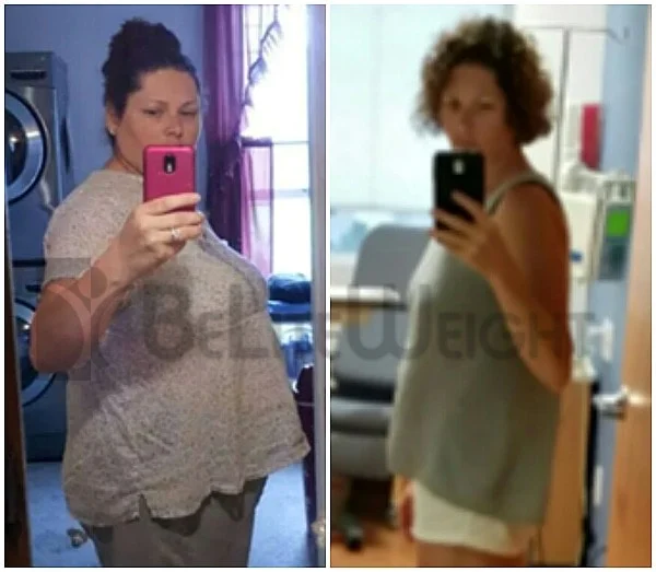 Gastric Sleeve Weight Loss Results