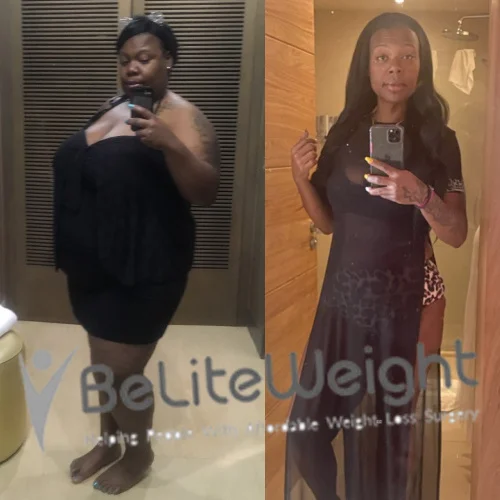 Weight Loss Surgery Gastric Sleeve before and after