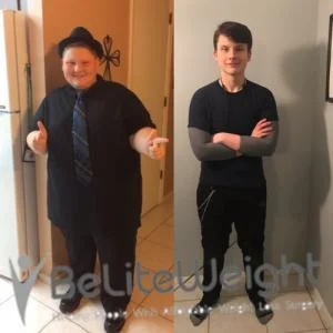 Weight Loss Surgery Before And After