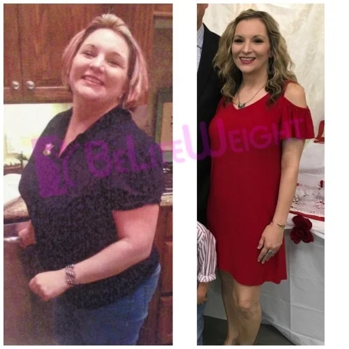Weight Loss Surgery before and after Patient - Procedure Gastric SleeveSurgeons: The surgical team of Dr. Jose Rodriguez-Villarreal, M.D., F.A.C.S* See Below