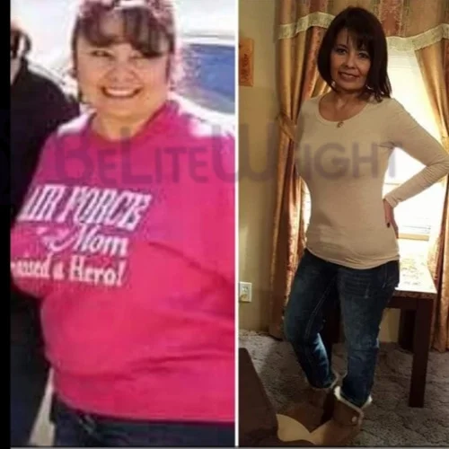 Gastric Sleeve