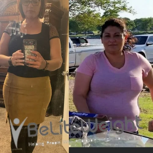 Weight Loss Surgery Gastric Sleeve before and after
