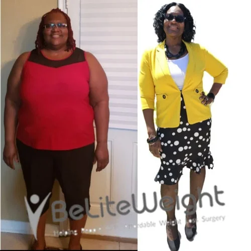Weight Loss Surgery Gastric Sleeve before and after
