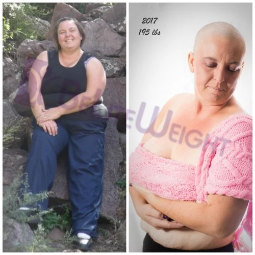 Weight Loss Surgery before and after Patient - I have been struggling with my weight for as long as I can remember.  My...