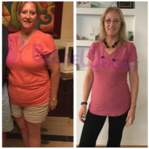 Weight Loss Surgery before and after Patient - After completing my 1 year surgeversary I am happy to say I lost 72 lbs....