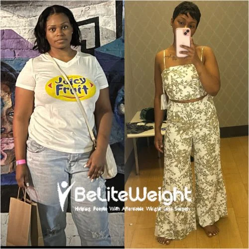 Weight Loss Surgery Before and After