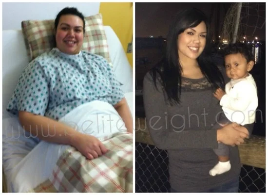 Gastric Sleeve Surgery Before and After Photos - VSG #wls #weightlosssurgery