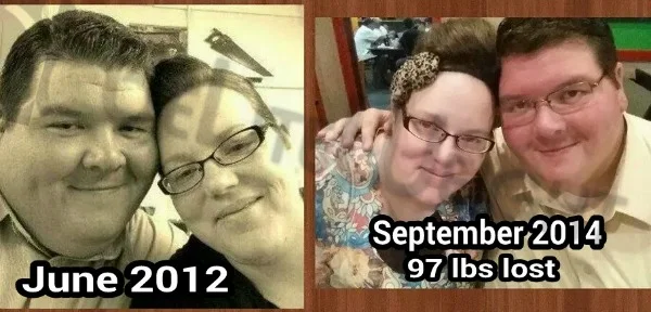 VSG - Vertical Sleeeve Gastrectomy