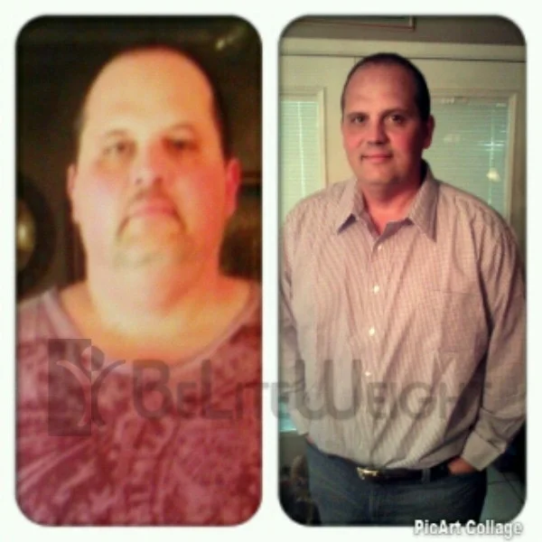 Revision of a prior weight loss surgery