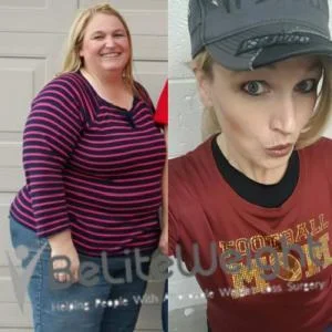 Weight Loss Surgery Before And After