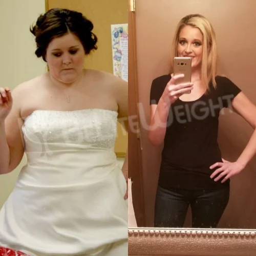 Gastric Sleeve to RNY Bypass