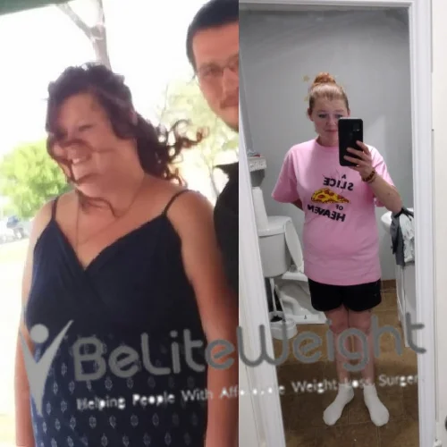 Weight Loss Surgery Before And After
