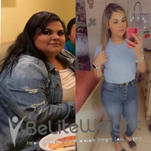 Weight Loss Surgery Before And After