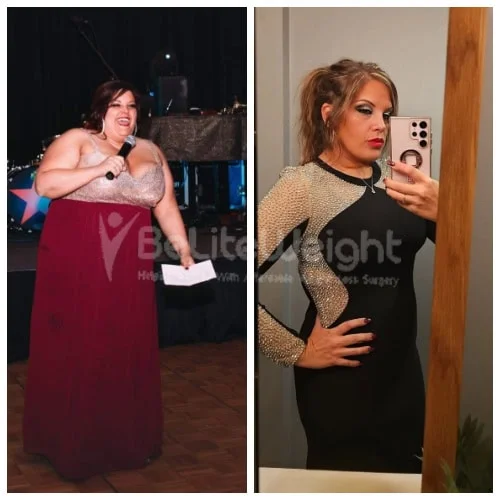 RNY Gastric Bypass before and after Patient - Hi JoAnne! I'm doing well. I've gained a bit back but only about 5-7lbs. Otherwise...