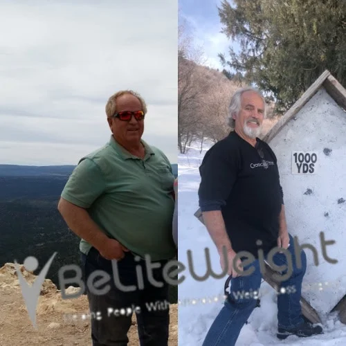 Weight Loss Surgery Before And After