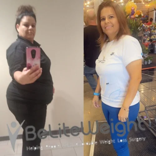 Weight Loss Surgery Before And After