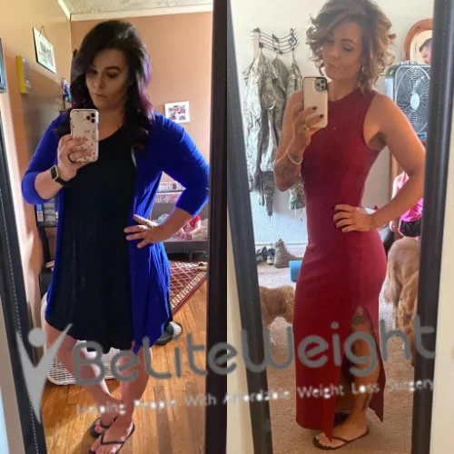 Weight Loss Surgery Before And After