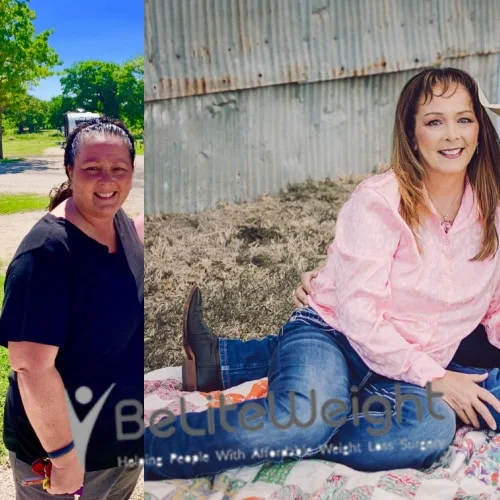 Weight Loss Surgery Gastric Sleeve before and after