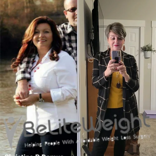 Weight Loss Surgery Before And After