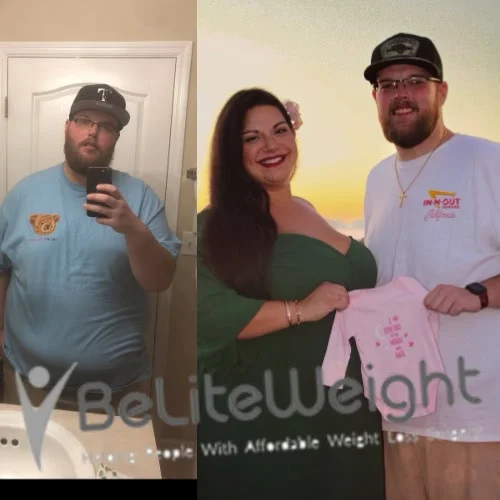 Weight Loss Surgery Gastric Sleeve before and after