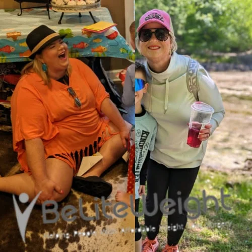 Weight Loss Surgery Gastric Sleeve before and after