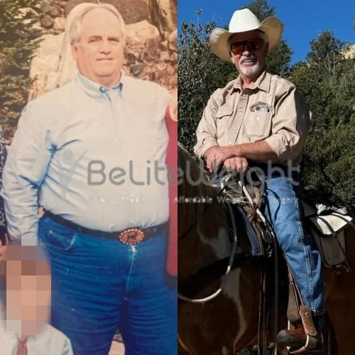 Weight Loss Surgery Before and After