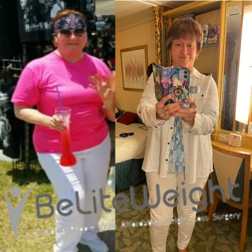 Weight Loss Surgery Before And After