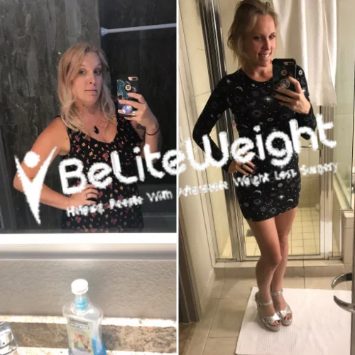 Gastric Sleeve before and after Patient - I am so glad I made this decision and did it while I was young.I've...