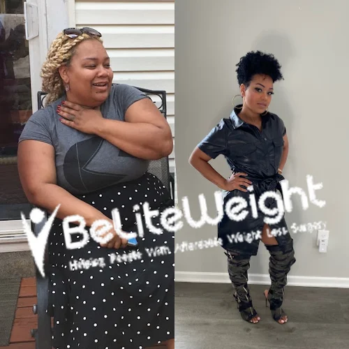 Gastric Sleeve before and after Patient - I FEEL GREAT!!! I have been able to maintain keeping the weight off and I...