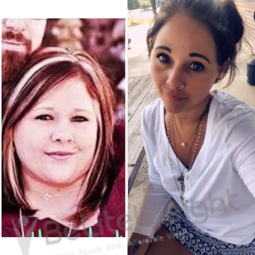 Vertical Sleeve Gastrectomy Before and After