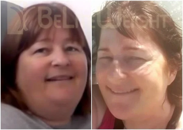 VSG - Vertical Sleeeve Gastrectomy