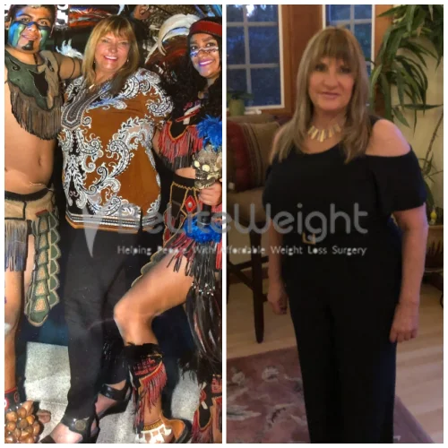 Weight Loss Surgery Bypass Revision Surgery before and after