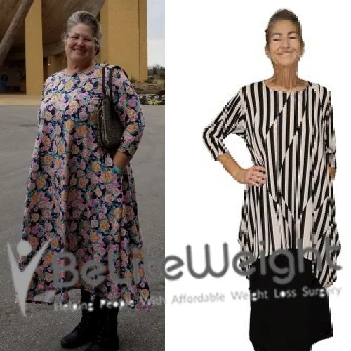 Weight Loss Surgery Gastric Sleeve before and after