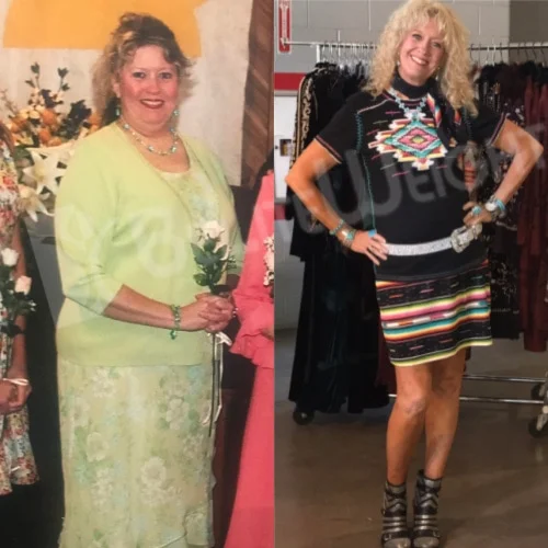 Revision of Gastric Bypass Surgery