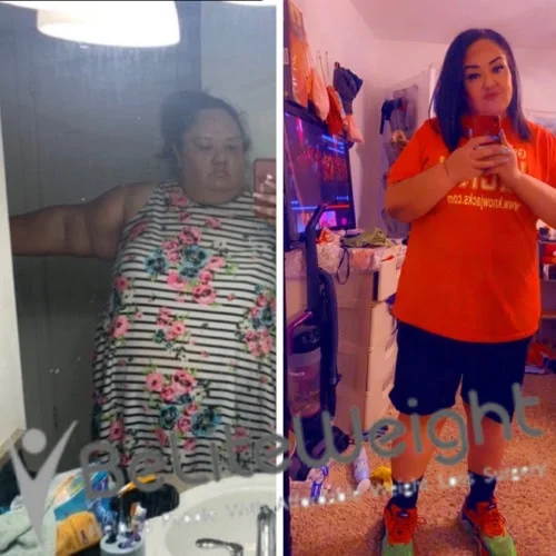 Weight Loss Surgery Before And After