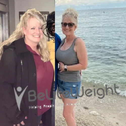 Weight Loss Surgery Gastric Sleeve before and after